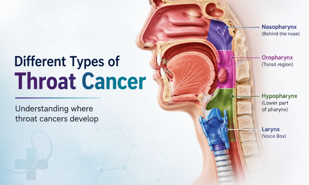 Different Types of Throat Cancer Pharynx, Larynx, Tonsil & More